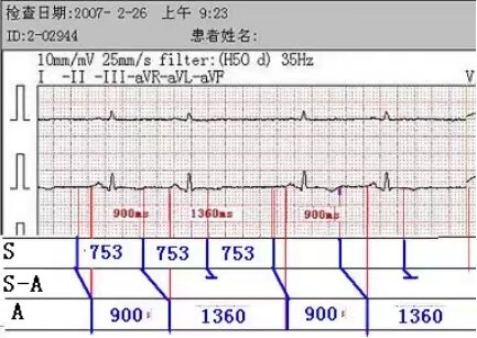 另类心电图讲义-8---心脏传导阻滞-房室传导阻